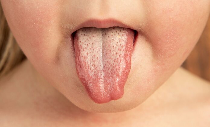 What-are-the-symptoms-of-scarlet-fever-and-is-it.jpg